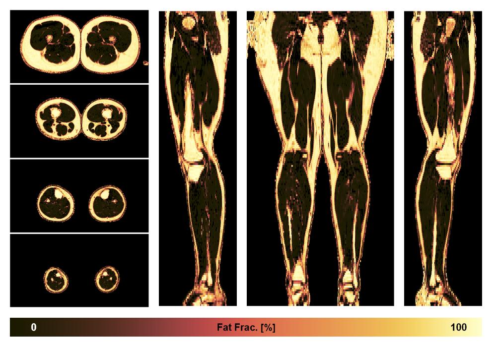 The fat fraction of the lower extremity obtained from the dixon reconstruction for muscle water fat quantification.